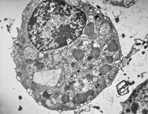 M,62y. | bone marrow - plasmocytoma